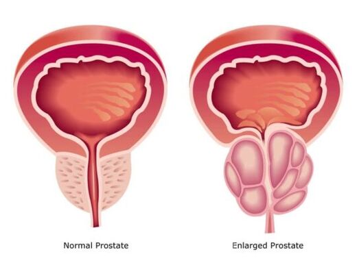 Normalna i povećana prostata