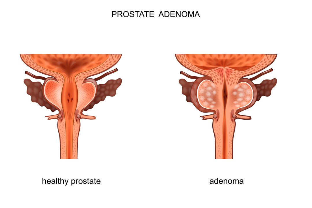 zdrava prostata i s adenomom